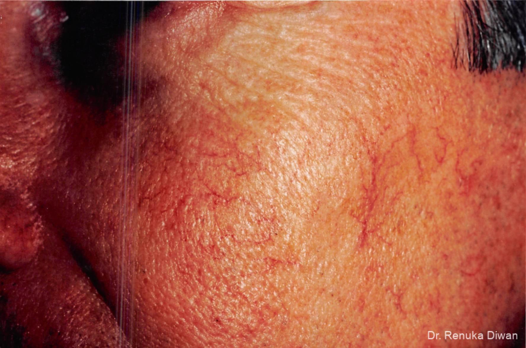 Laser-for-veins-and-redness-for-men: Patient 5 - Before 