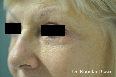 Blepharoplasty: Patient 6 - After  