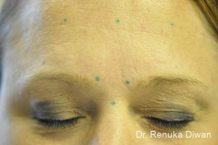 BOTOX® Cosmetic: Patient 31 - Before and After 1