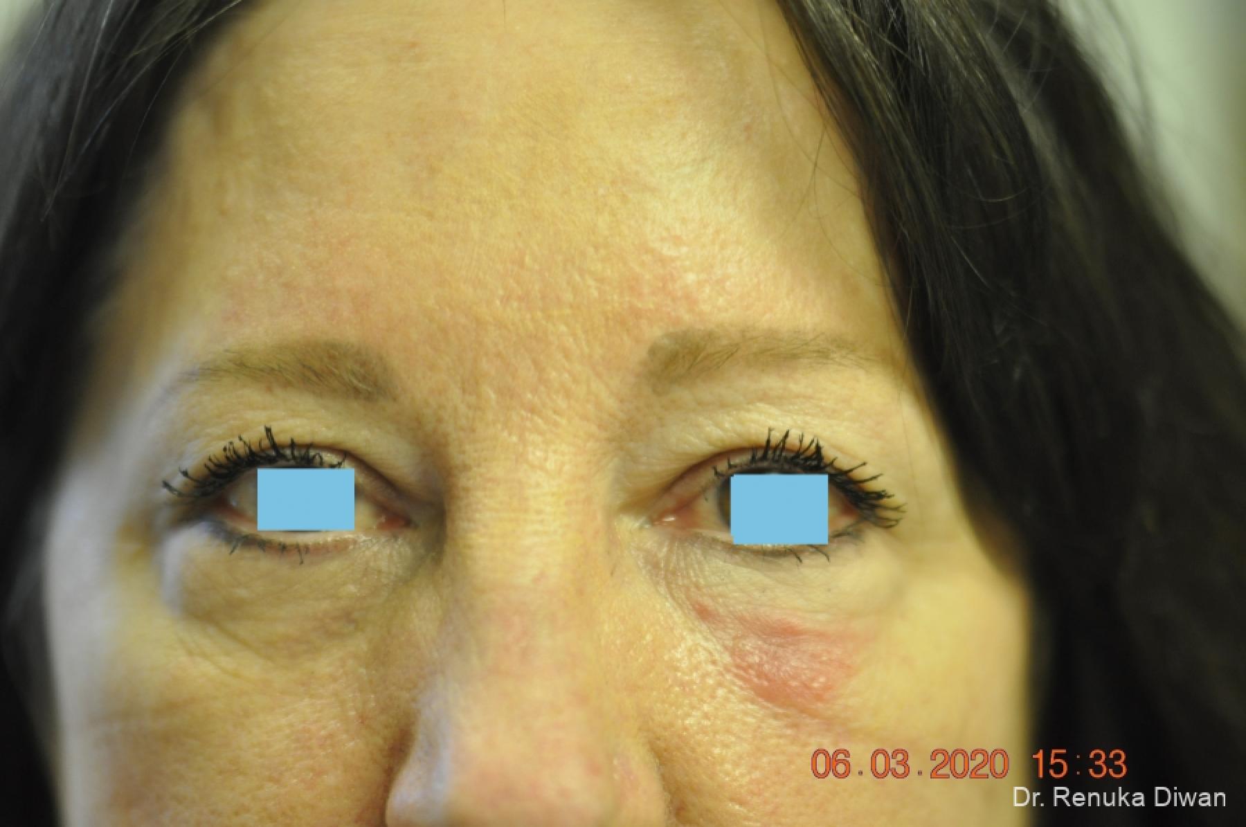 Blepharoplasty: Patient 3 - Before 