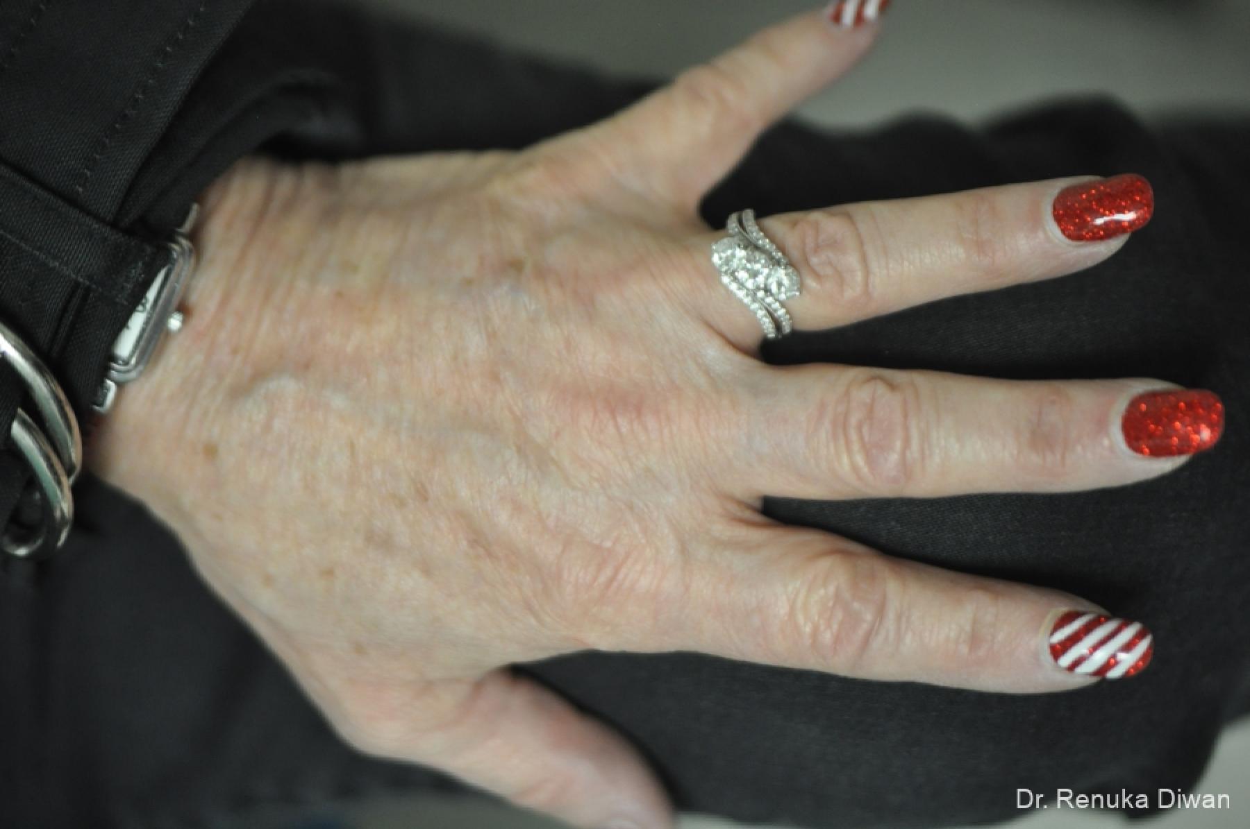 Hand Augmentation: Patient 1 - After  