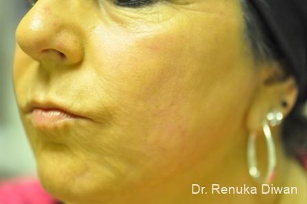 Laser Skin Resurfacing: Patient 1 - After  