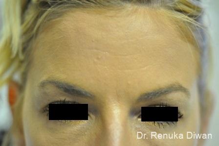 Forehead Creases: Patient 2 - After 1