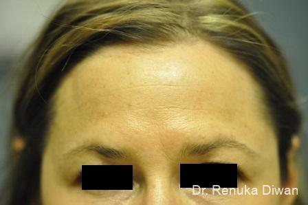 BOTOX® Cosmetic: Patient 14 - After 1