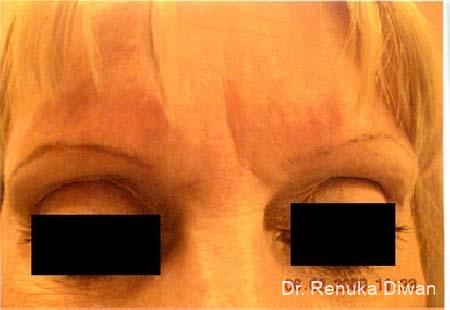 Frown Lines: Patient 3 - Before 