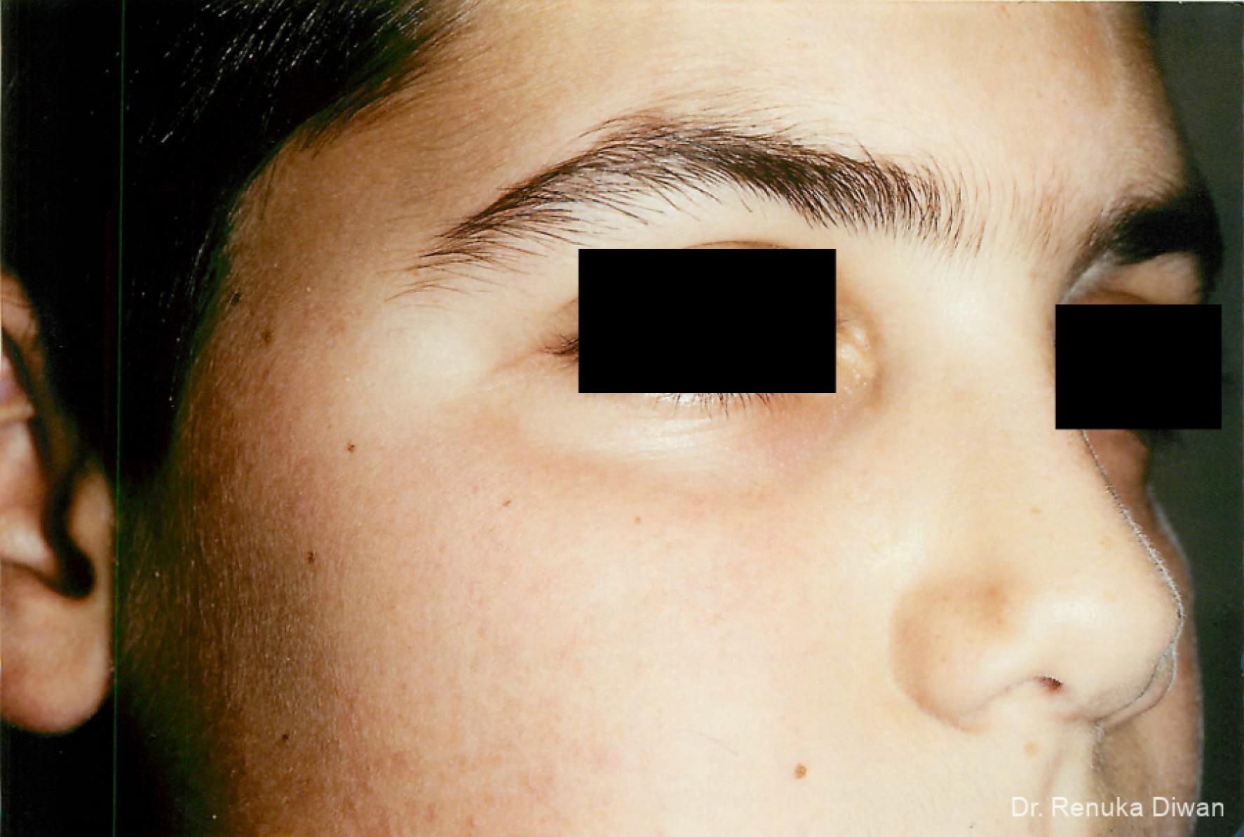 Laser For Veins And Redness: Patient 20 - After 1
