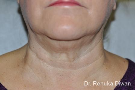 Kybella: Patient 3 - Before 