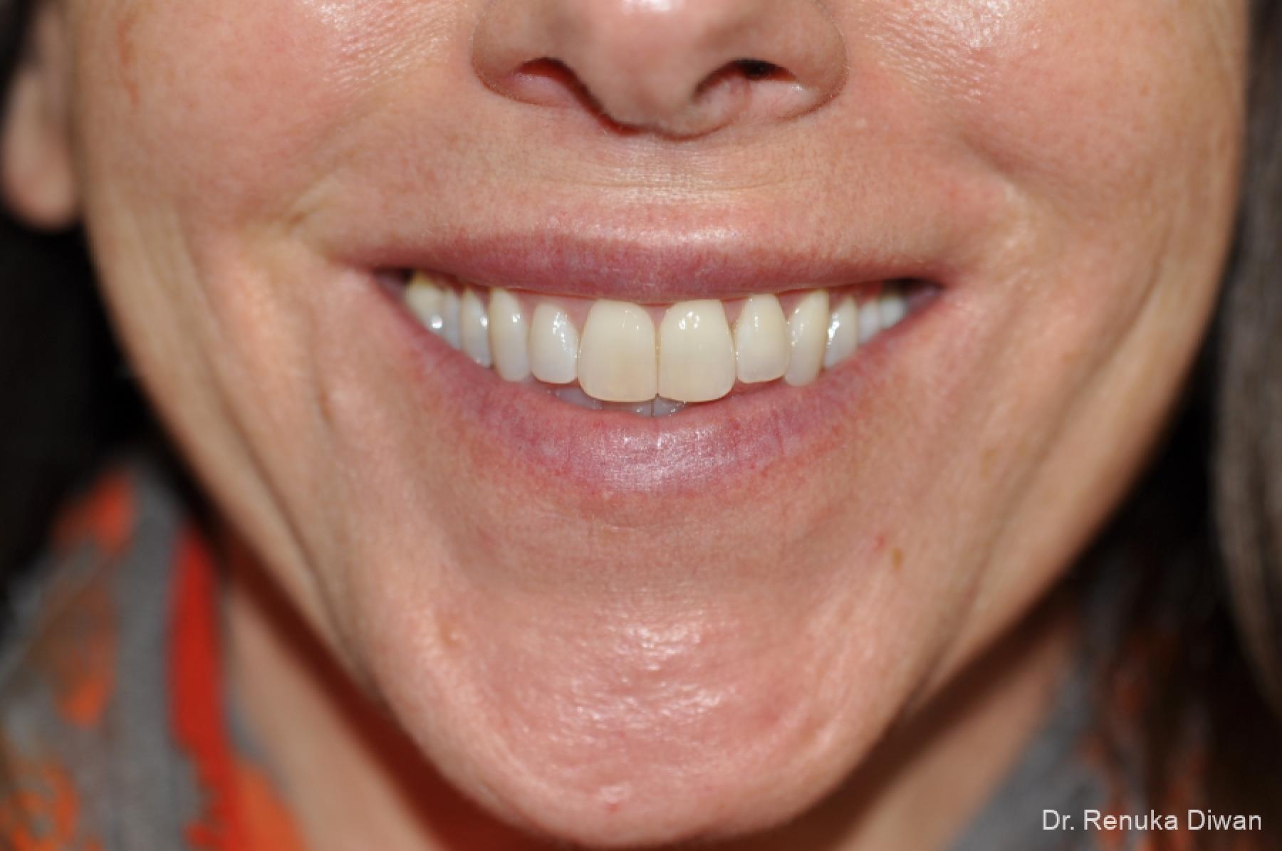 BOTOX® Cosmetic: Patient 29 - After 1