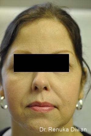 Skin Tightening: Patient 1 - After 2