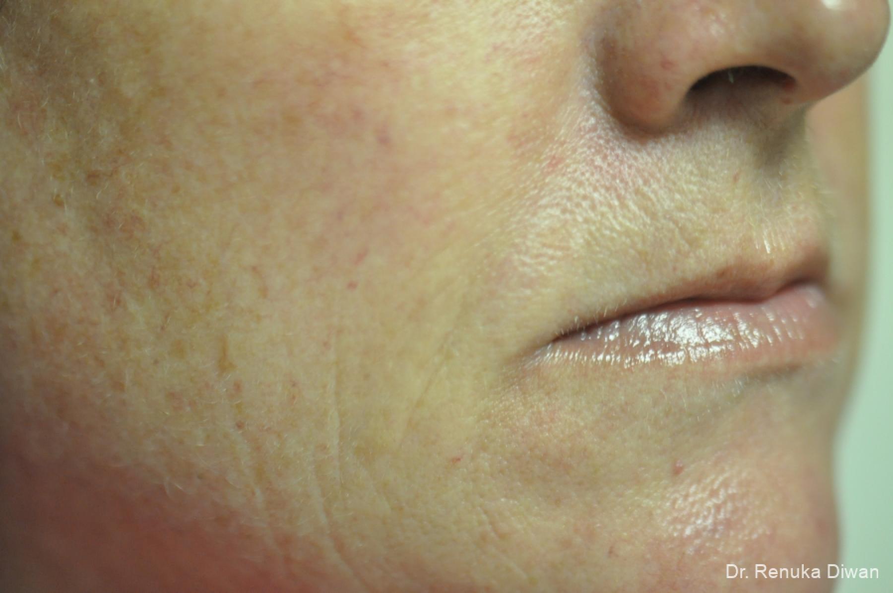 Microneedling: Patient 4 - After 1