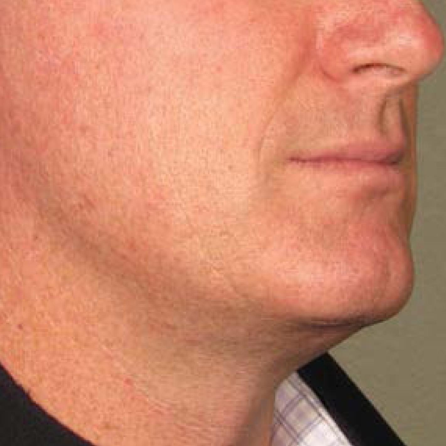 Ultherapy® - Chin: Patient 19 - Before 