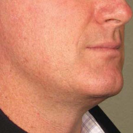 Ultherapy® - Chin: Patient 19 - Before
