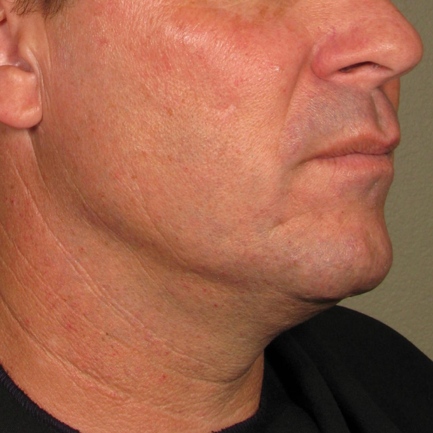 Ultherapy® - Chin: Patient 27 - After 1