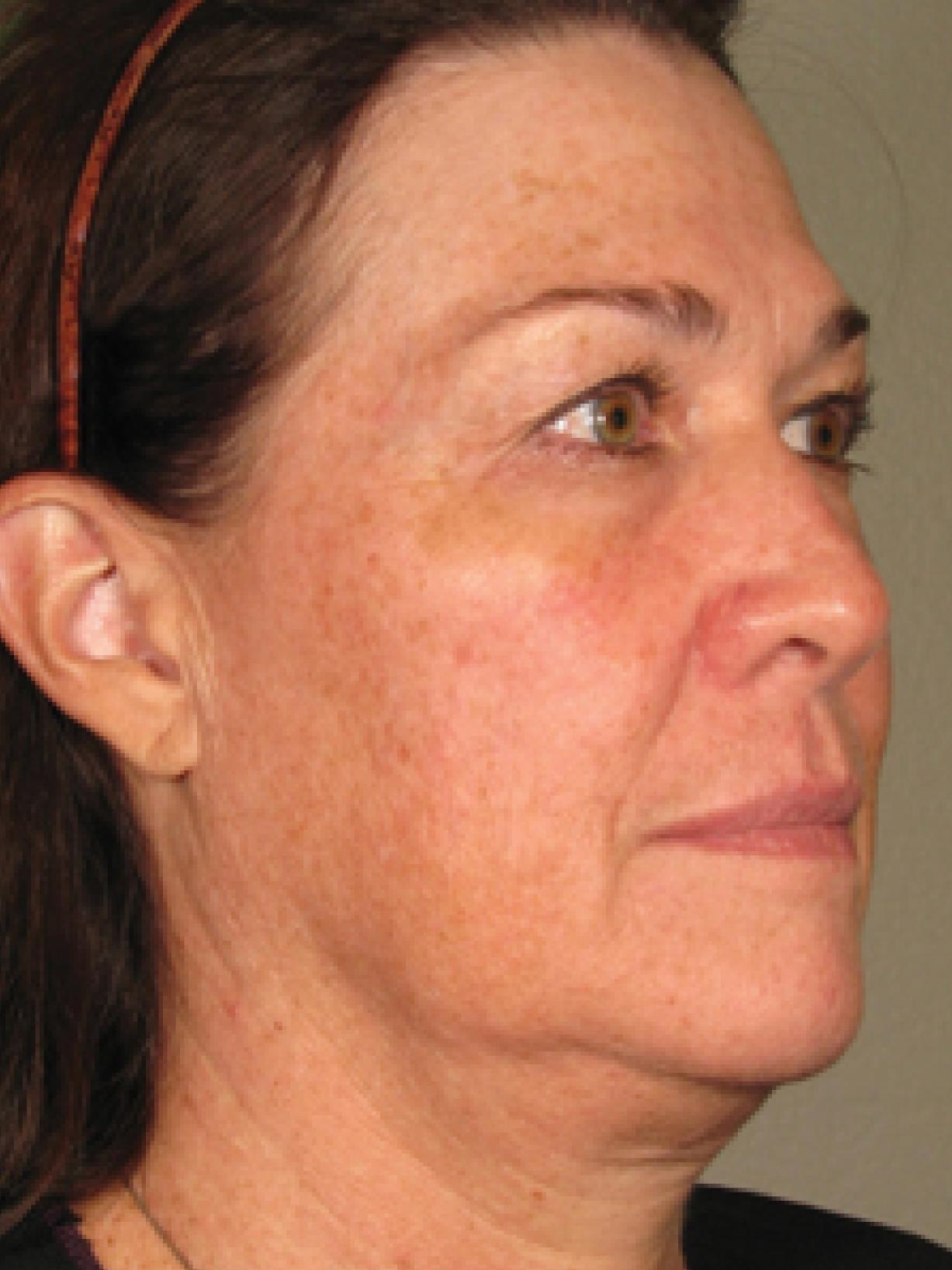 Ultherapy® - Face: Patient 2 - After  