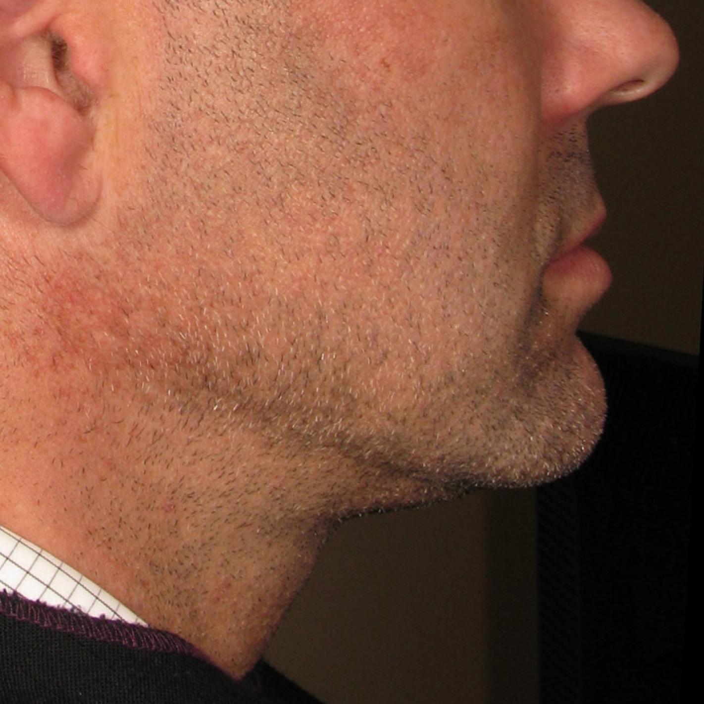 Ultherapy® - Chin: Patient 1 - After  