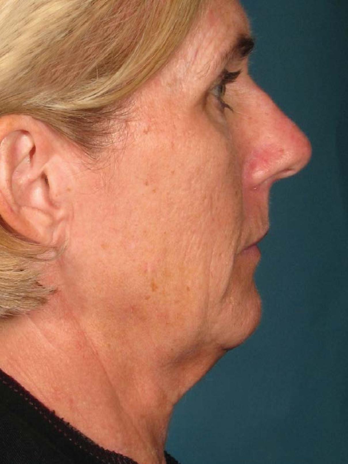 Ultherapy® - Face: Patient 15 - Before 