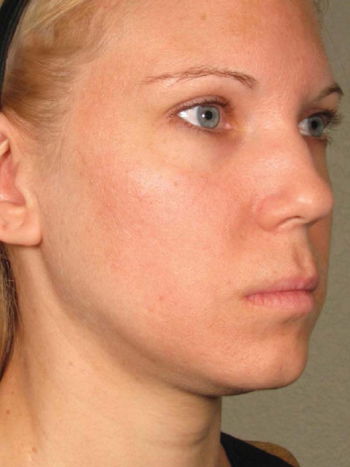 Ultherapy® - Face: Patient 11 - Before 