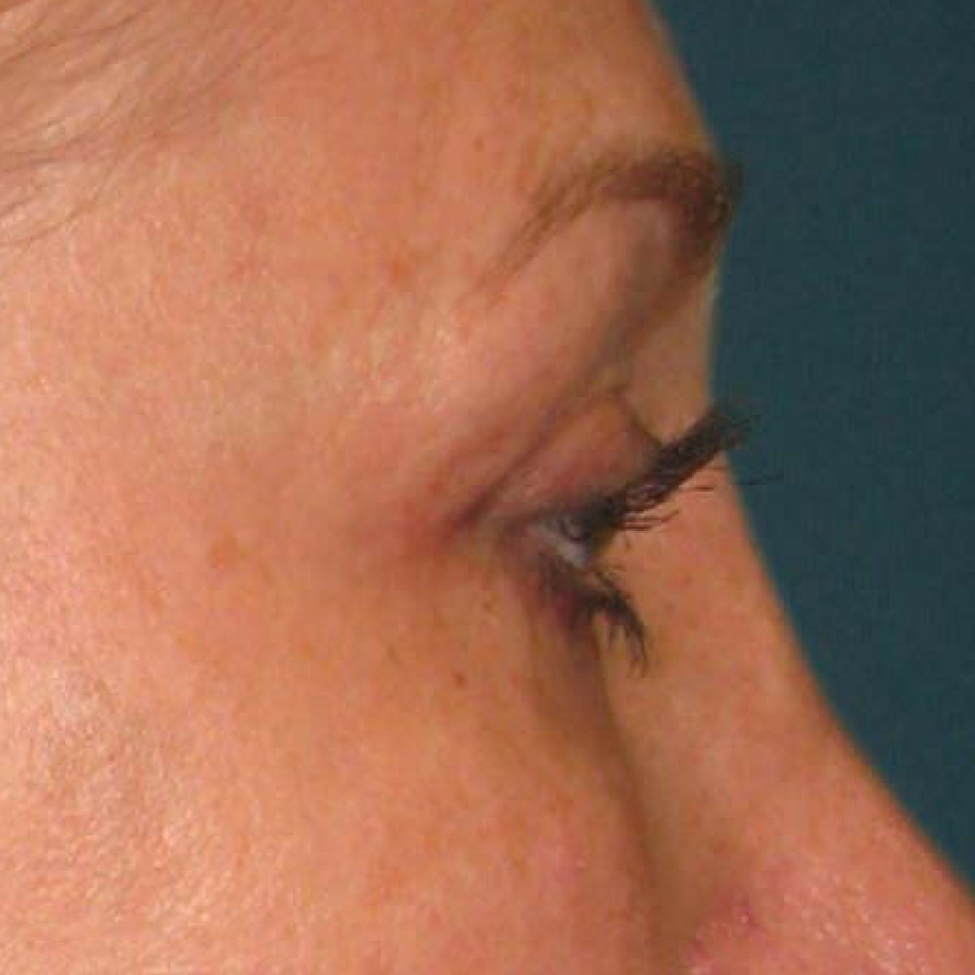 Ultherapy® - Brow: Patient 11 - After 1