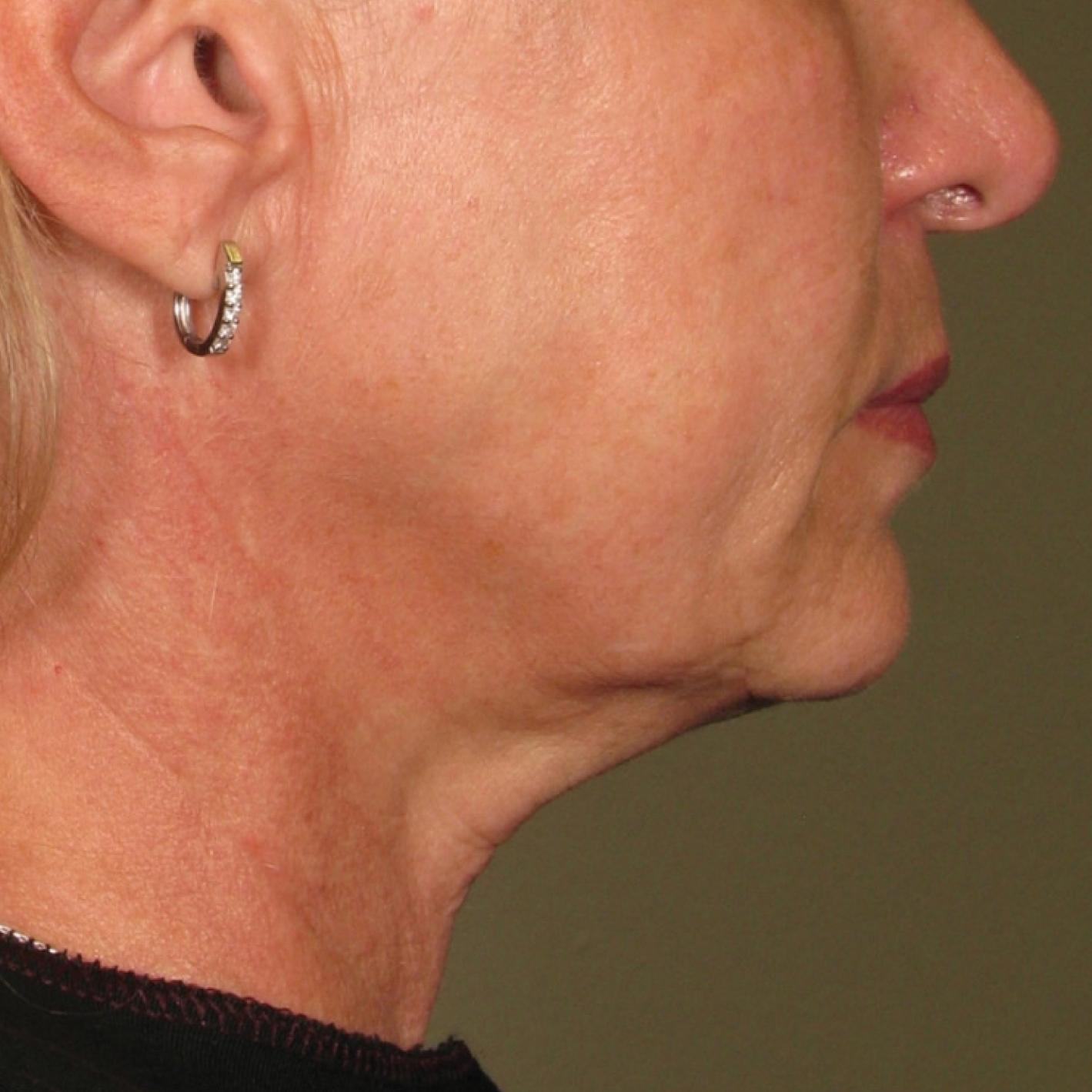 Ultherapy® - Chin: Patient 28 - After 