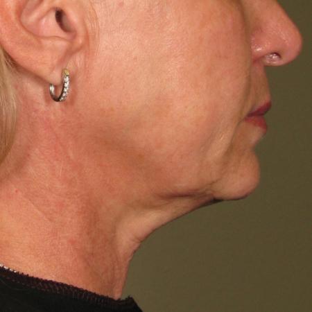 Ultherapy® - Chin: Patient 28 - After Image