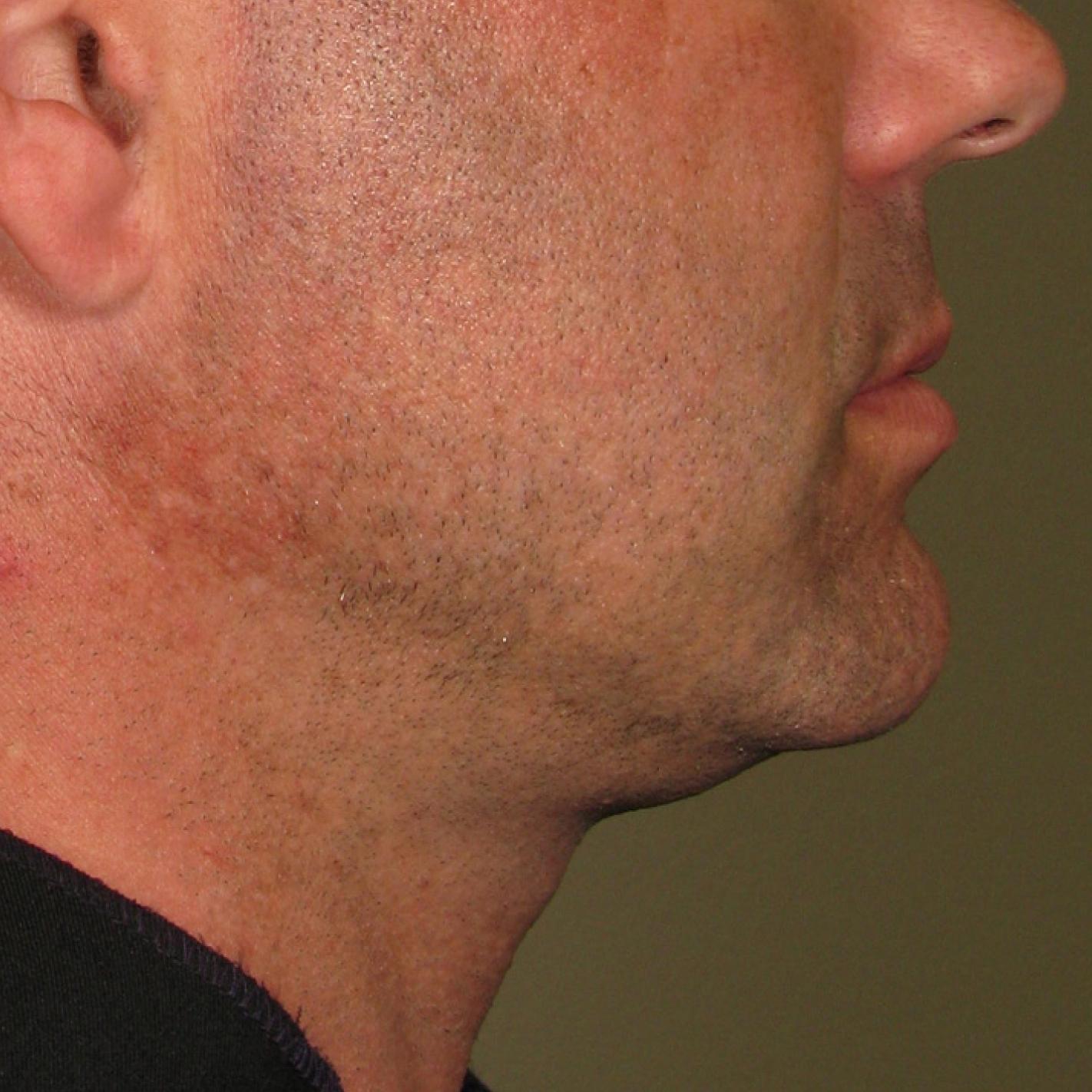 Ultherapy® - Chin: Patient 1 - Before 1