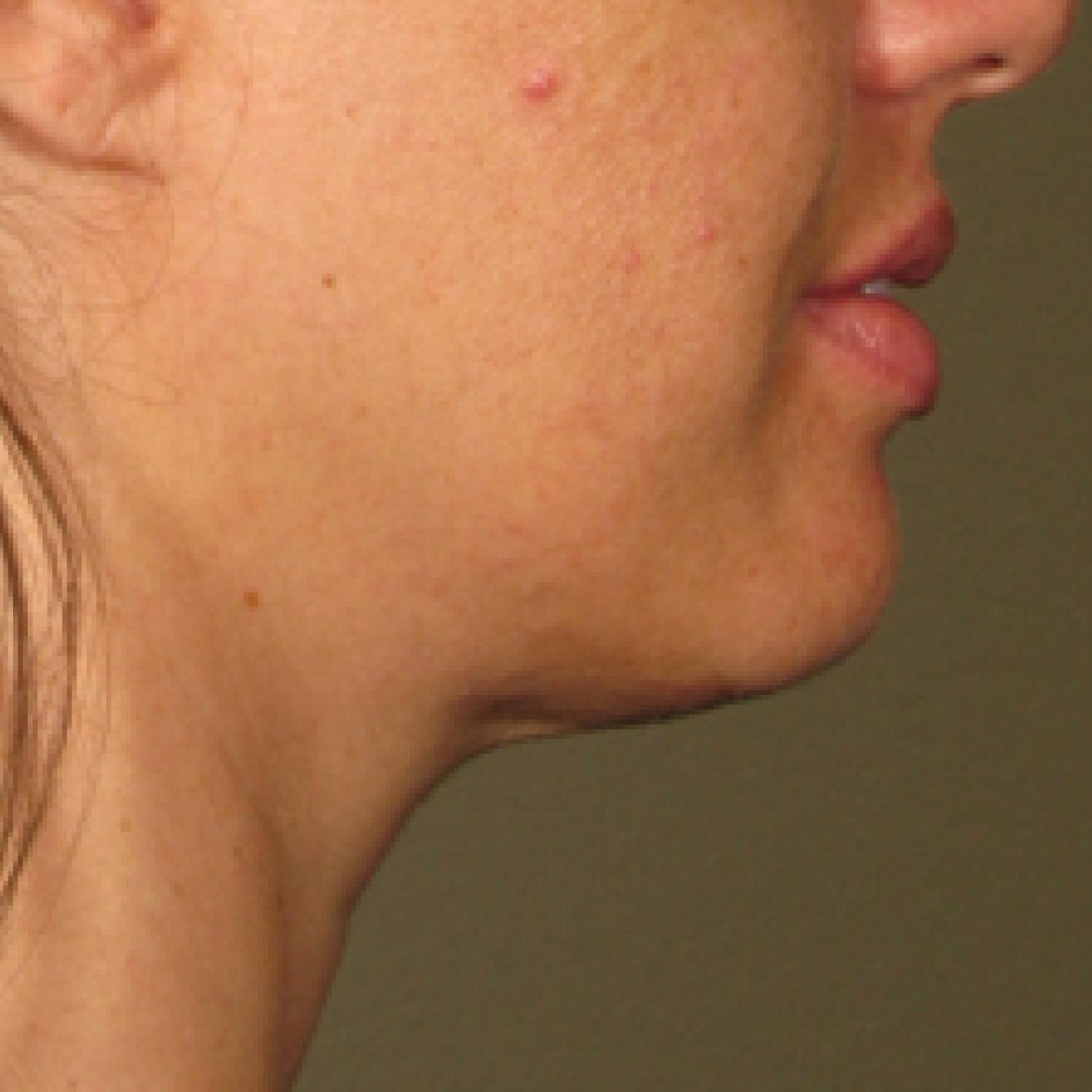 Ultherapy® - Chin: Patient 9 - Before 