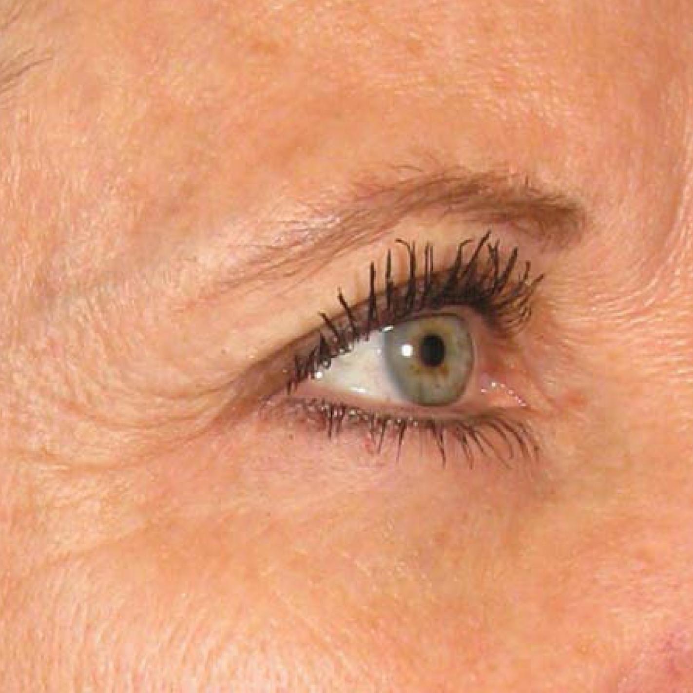 Ultherapy® - Brow: Patient 9 - Before 