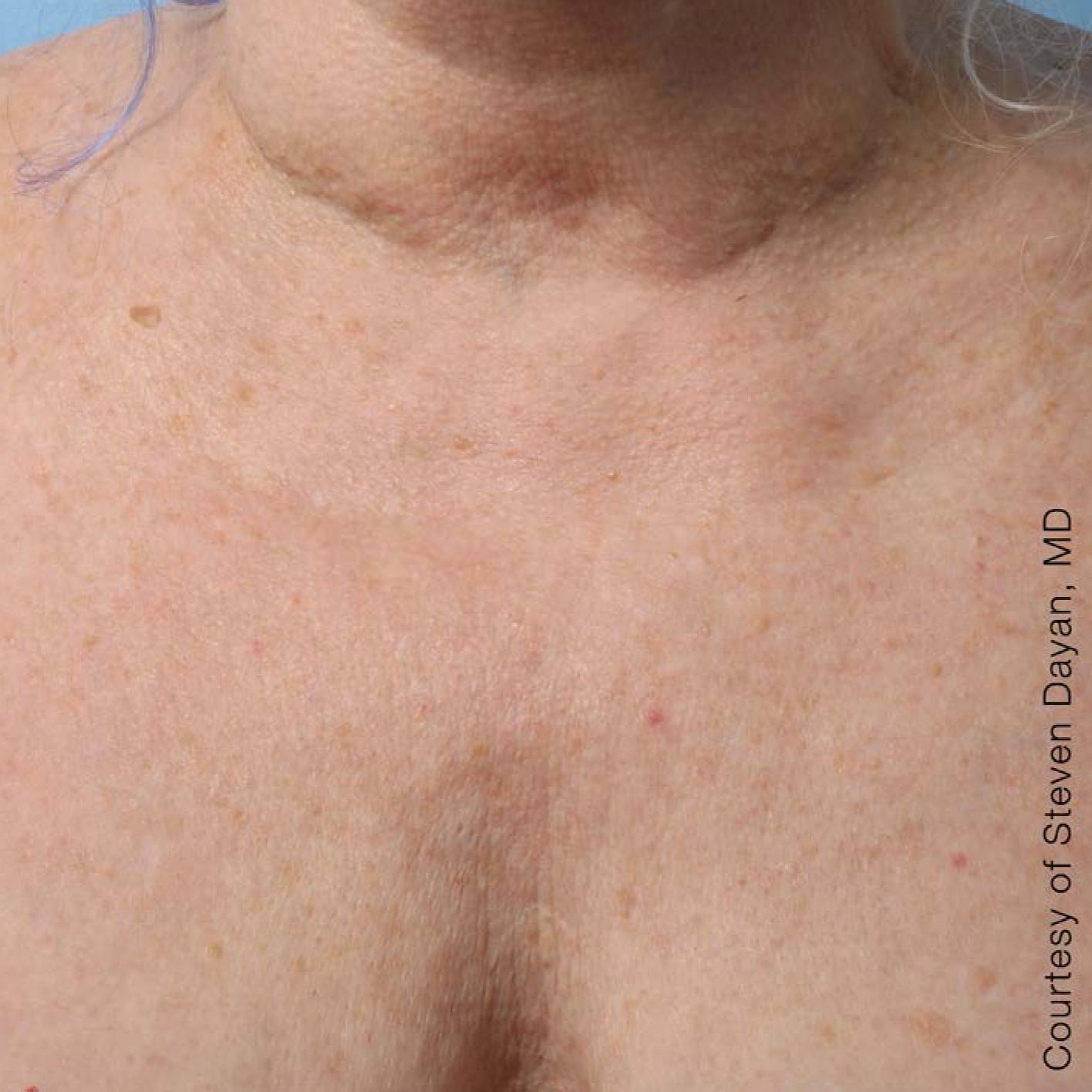 Ultherapy® - Décolletage: Patient 8 - After  