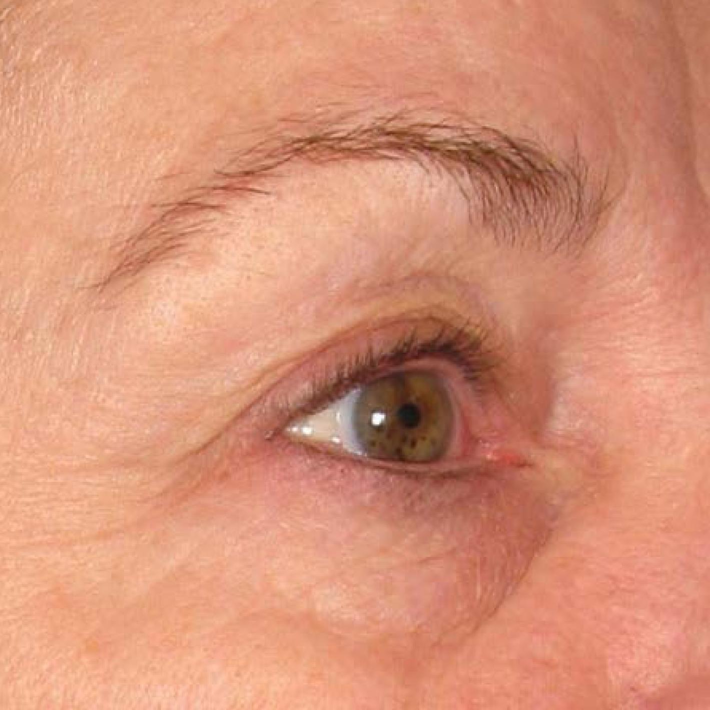 Ultherapy® - Brow: Patient 10 - After  