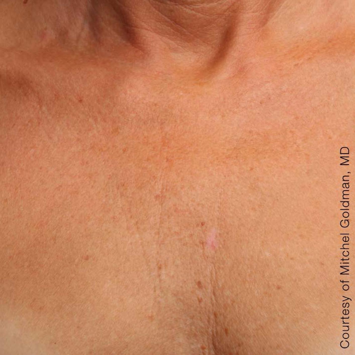 Ultherapy® - Décolletage: Patient 10 - After  
