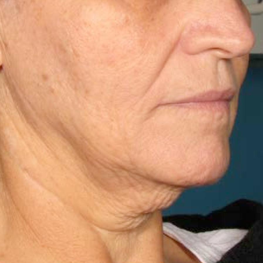 Ultherapy® - Chin: Patient 37 - Before 