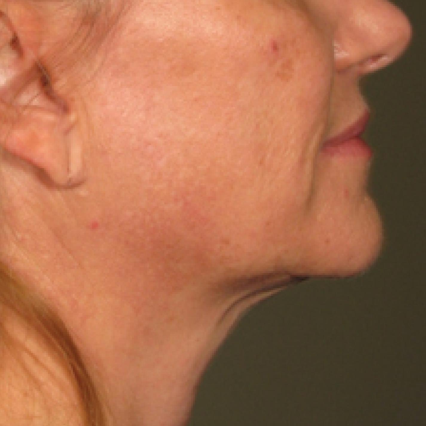 Ultherapy® - Chin: Patient 12 - After 