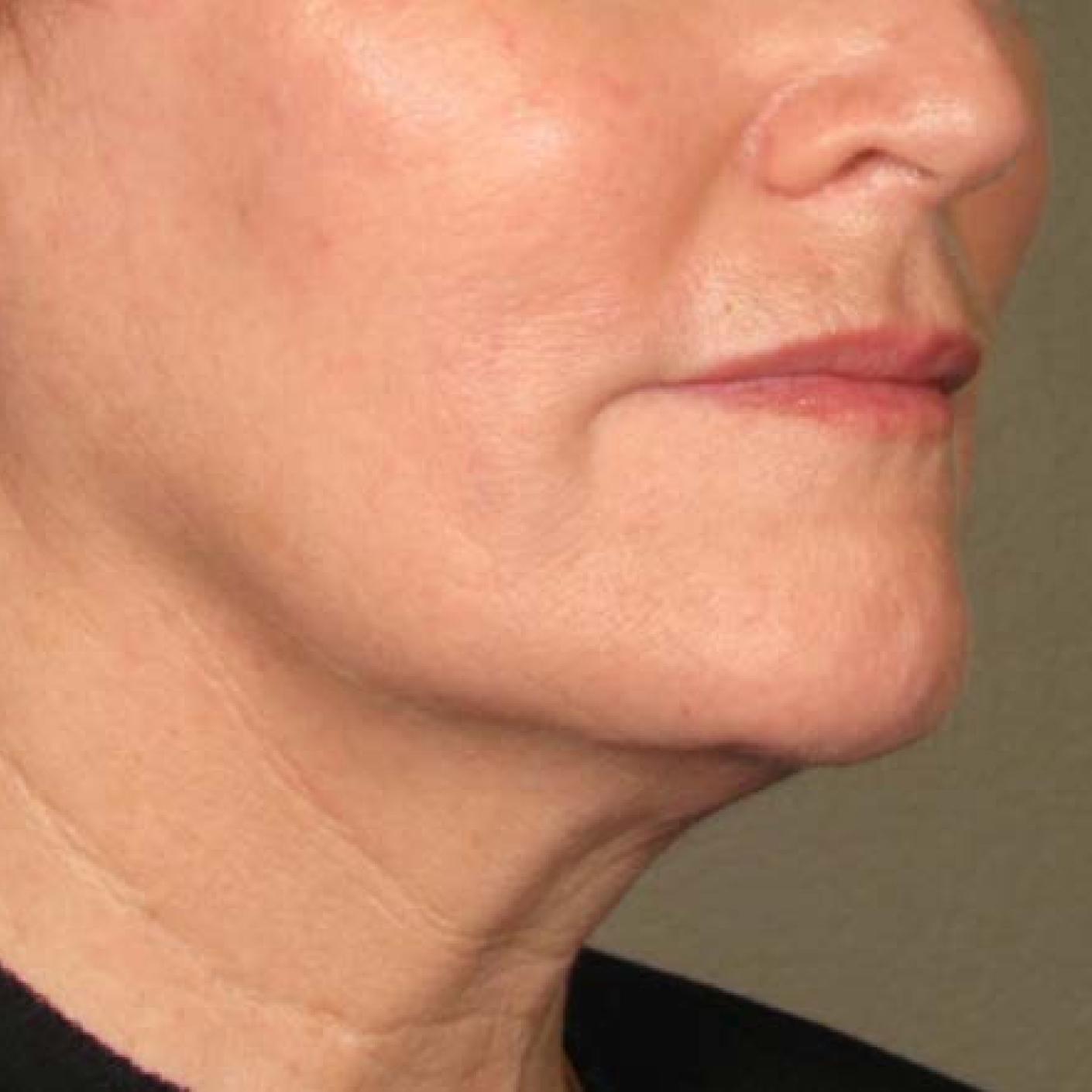 Ultherapy® - Chin: Patient 34 - After 