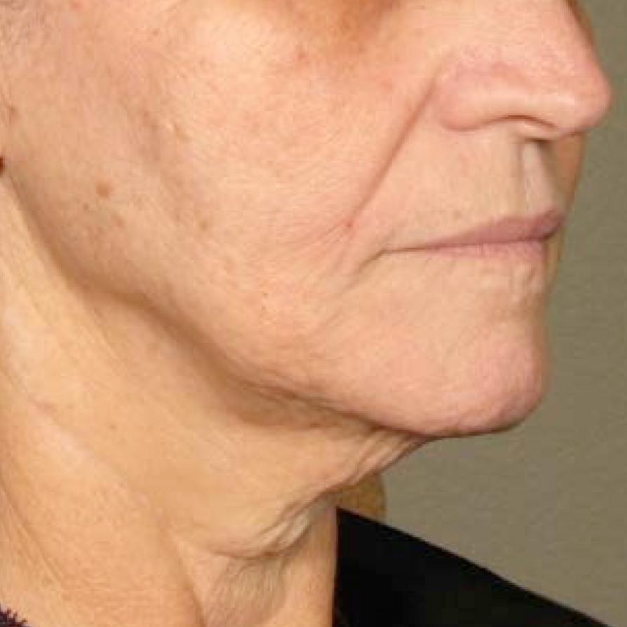 Ultherapy® - Chin: Patient 37 - After 