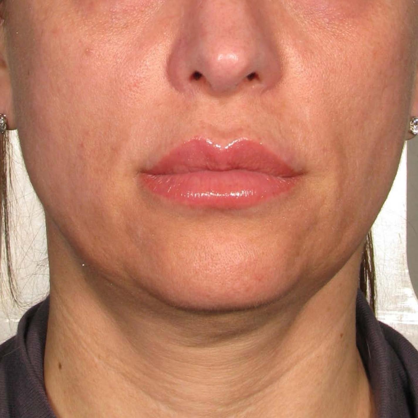 Ultherapy® - Chin: Patient 39 - Before 