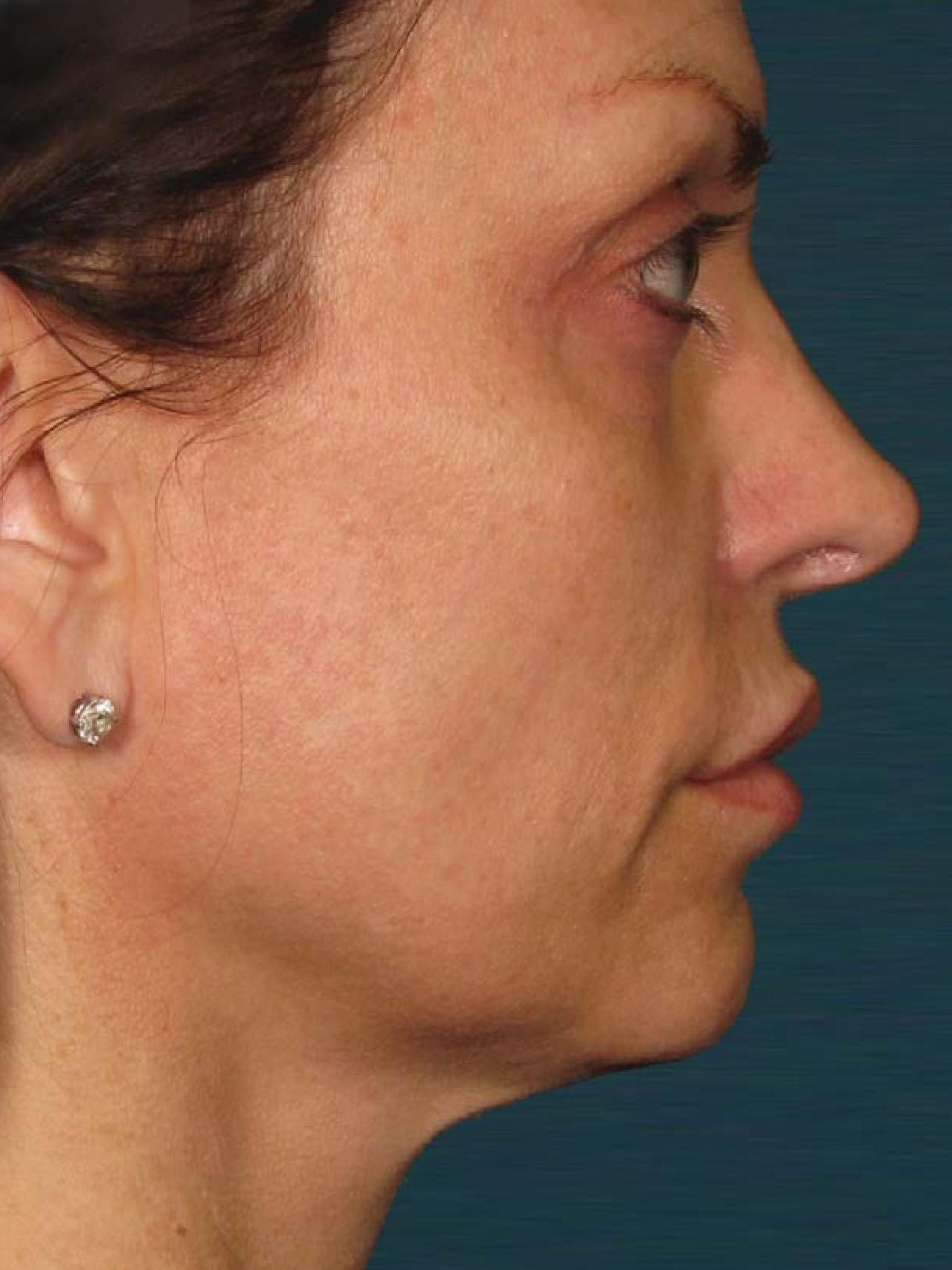 Ultherapy® - Face: Patient 24 - After 1
