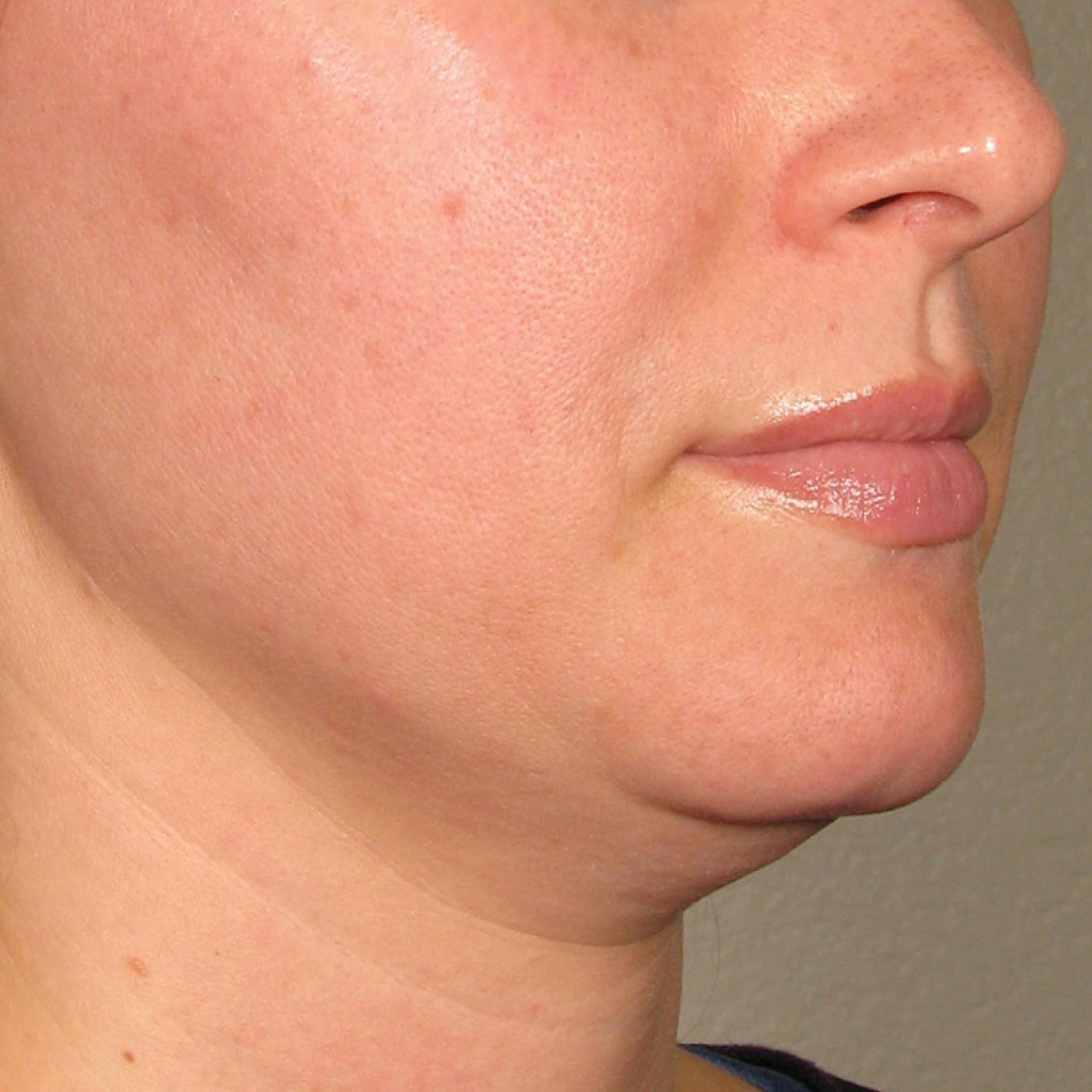 Ultherapy® - Chin: Patient 26 - Before 