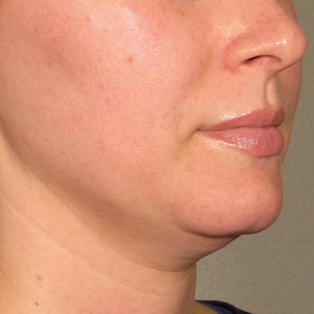 Ultherapy® - Chin: Patient 26 - Before Image