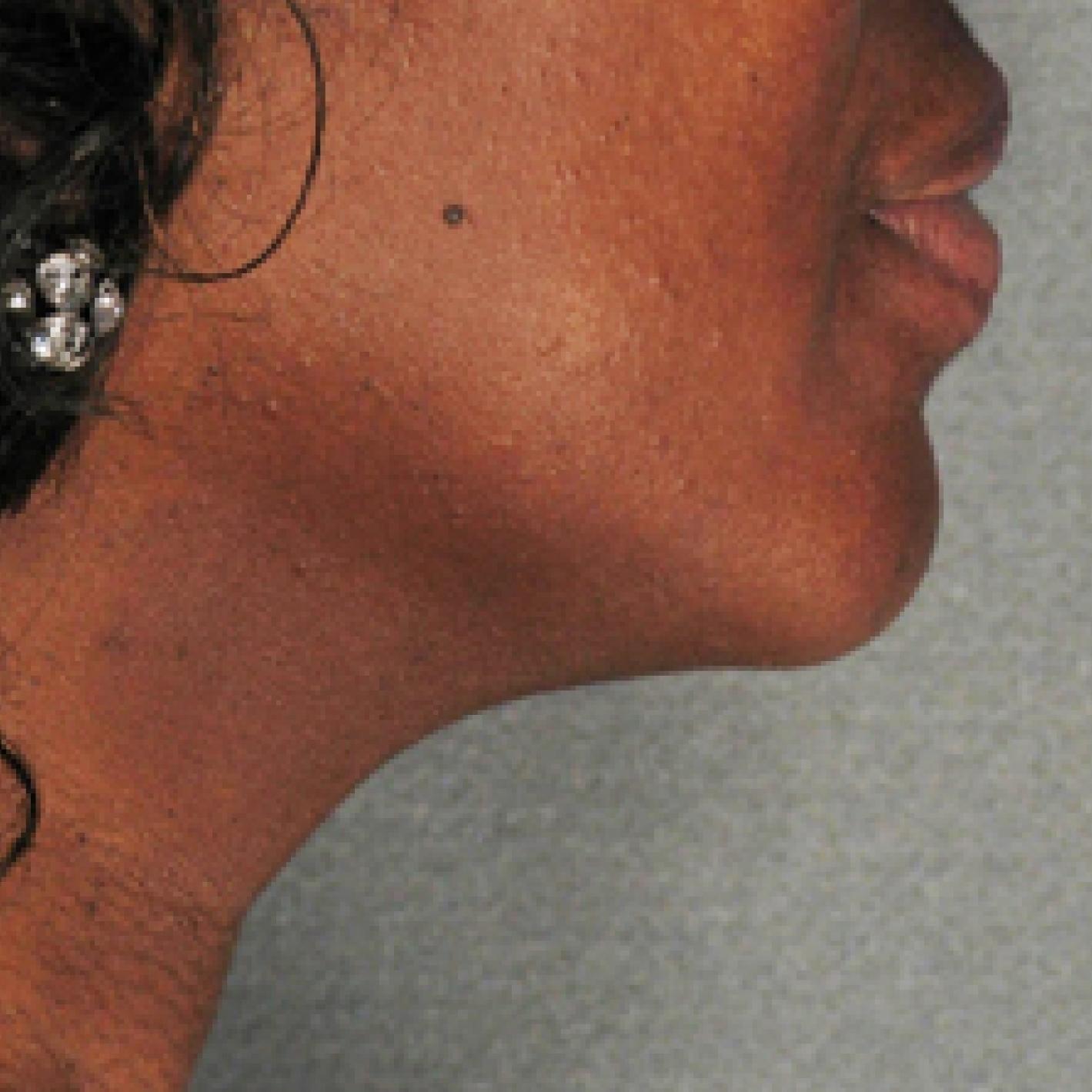 Ultherapy® - Chin: Patient 4 - After  
