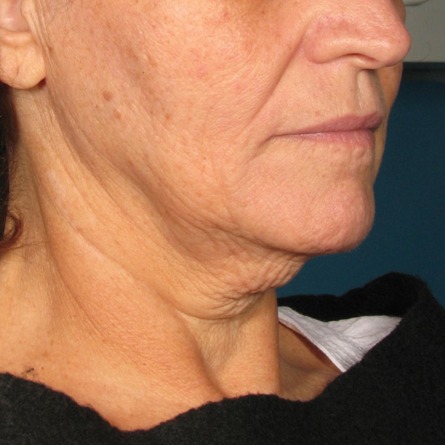 Ultherapy® - Chin: Patient 36 - Before 