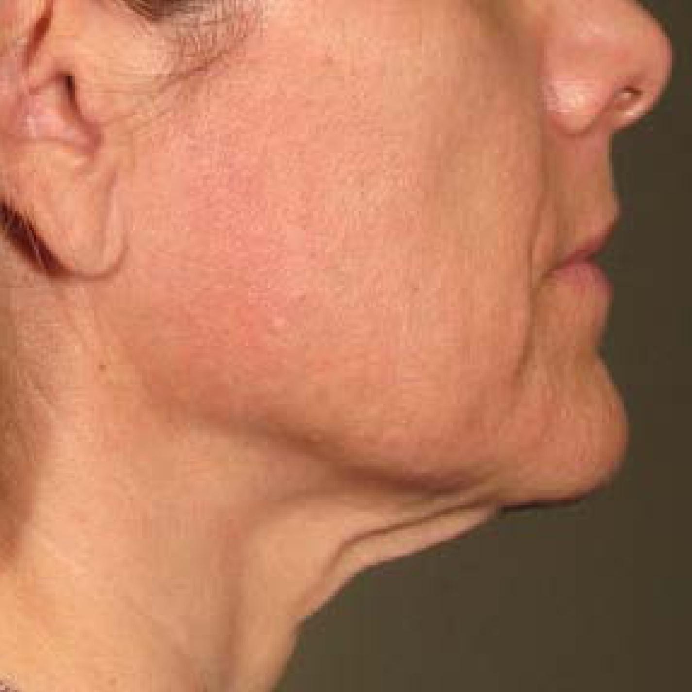 Ultherapy® - Chin: Patient 31 - After 