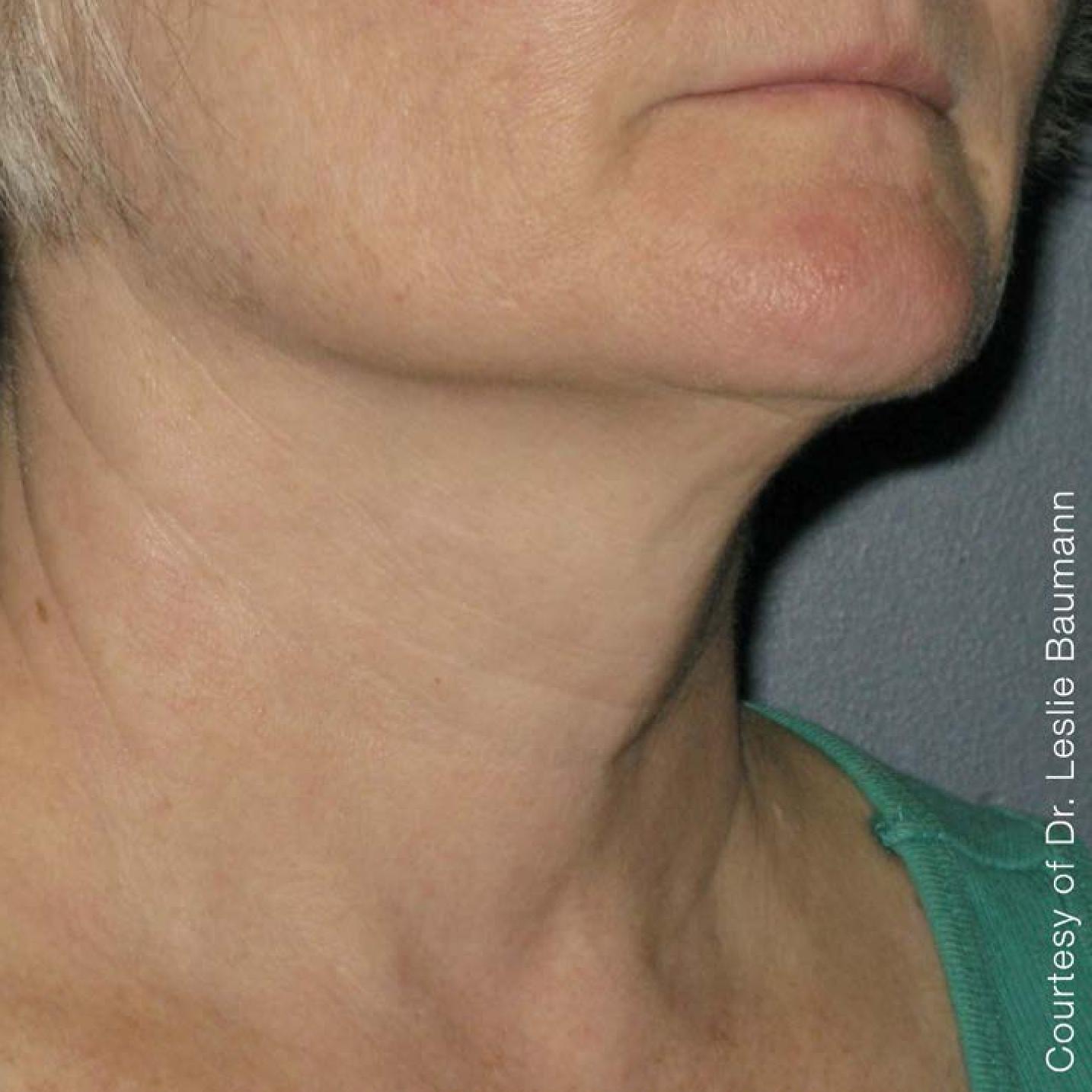 Ultherapy® - Neck: Patient 2 - After  