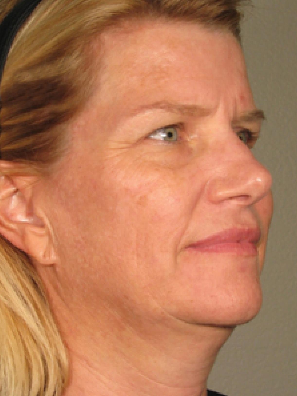 Ultherapy® - Face: Patient 3 - Before 1
