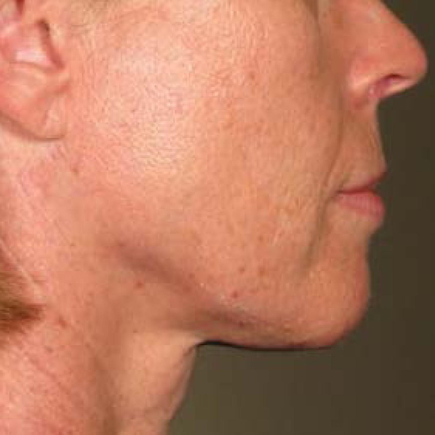 Ultherapy® - Chin: Patient 32 - After 