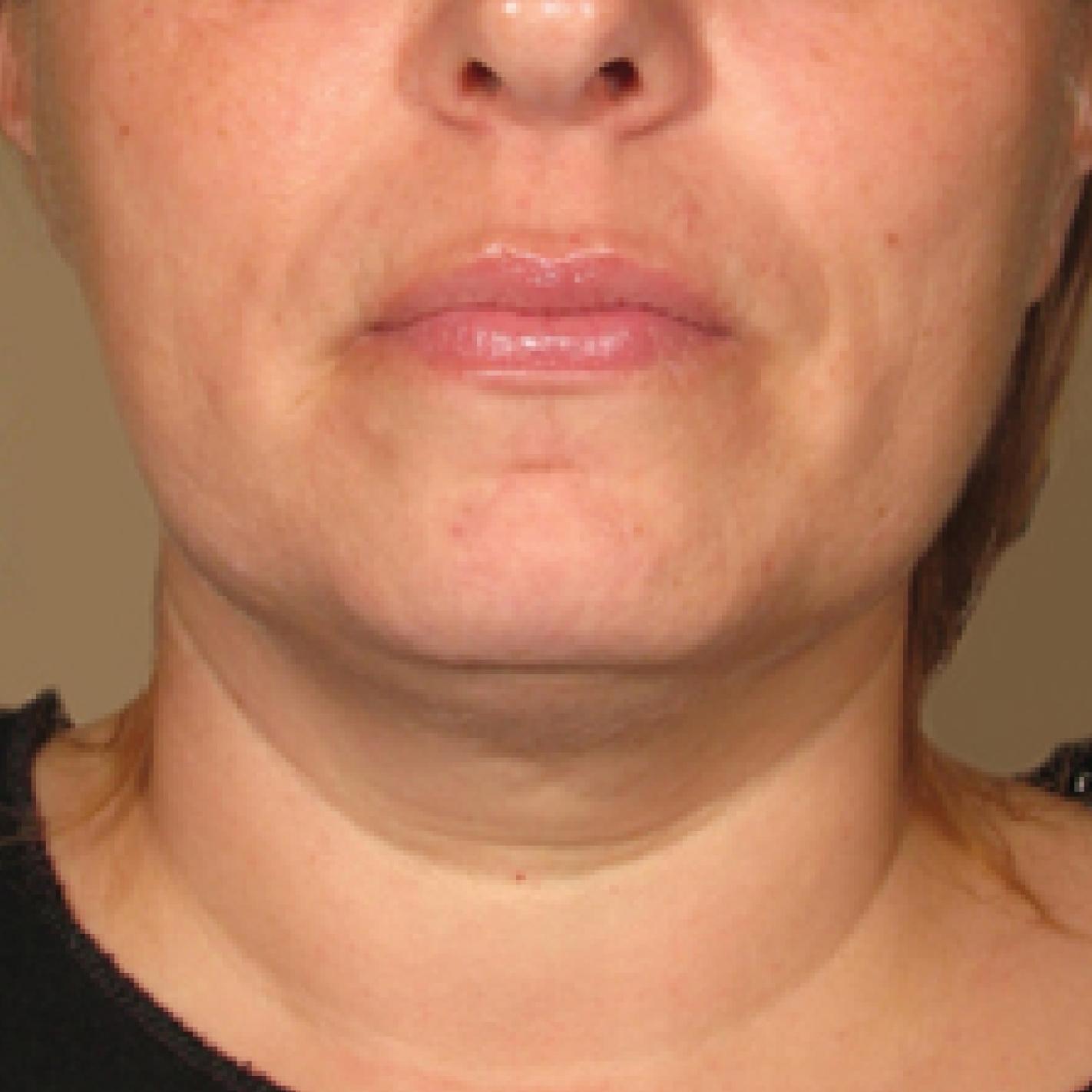 Ultherapy® - Chin: Patient 7 - After  
