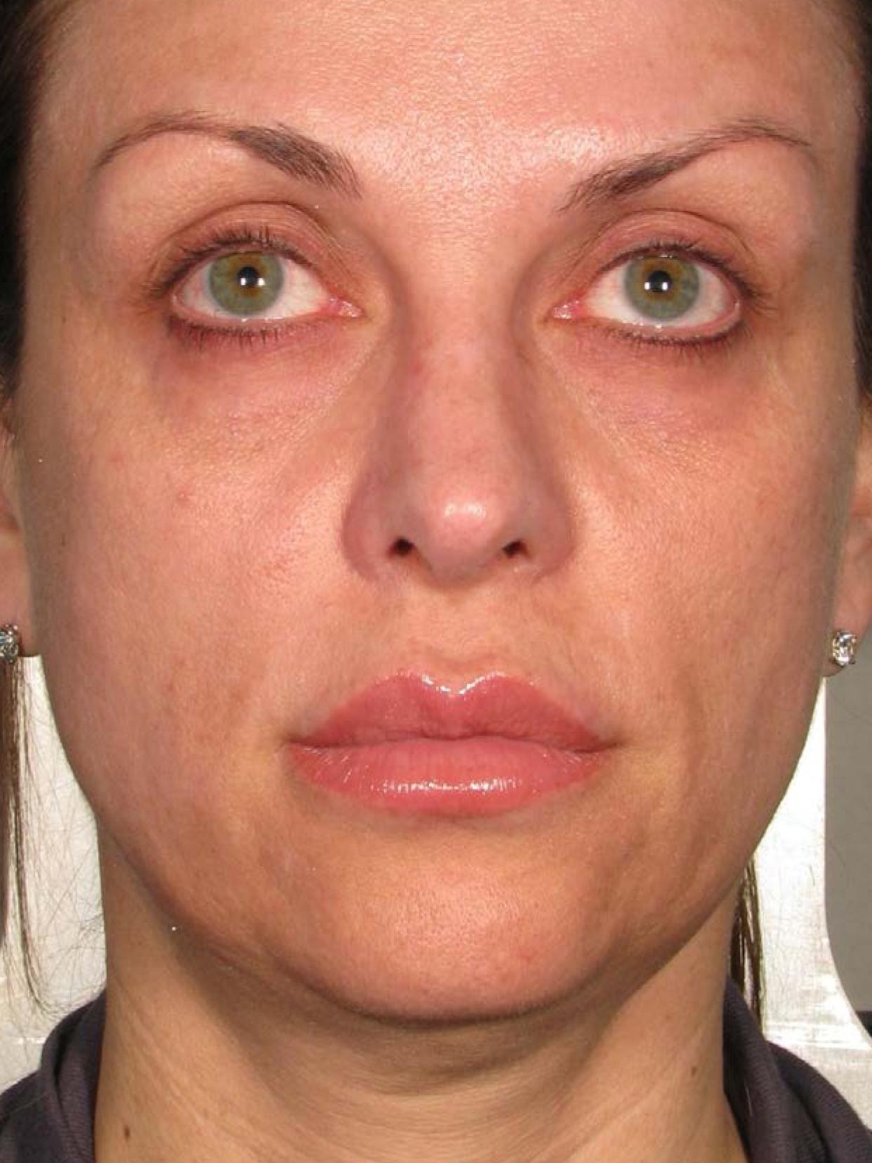 Ultherapy® - Face: Patient 23 - Before 