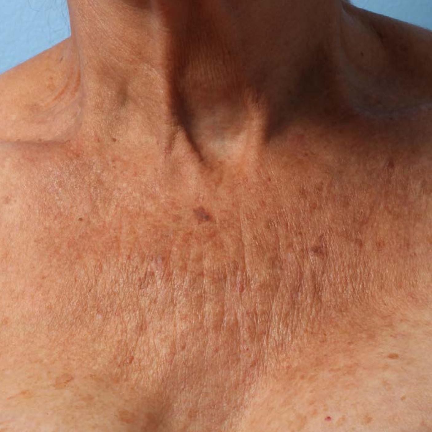 Ultherapy® - Décolletage: Patient 3 - Before 1