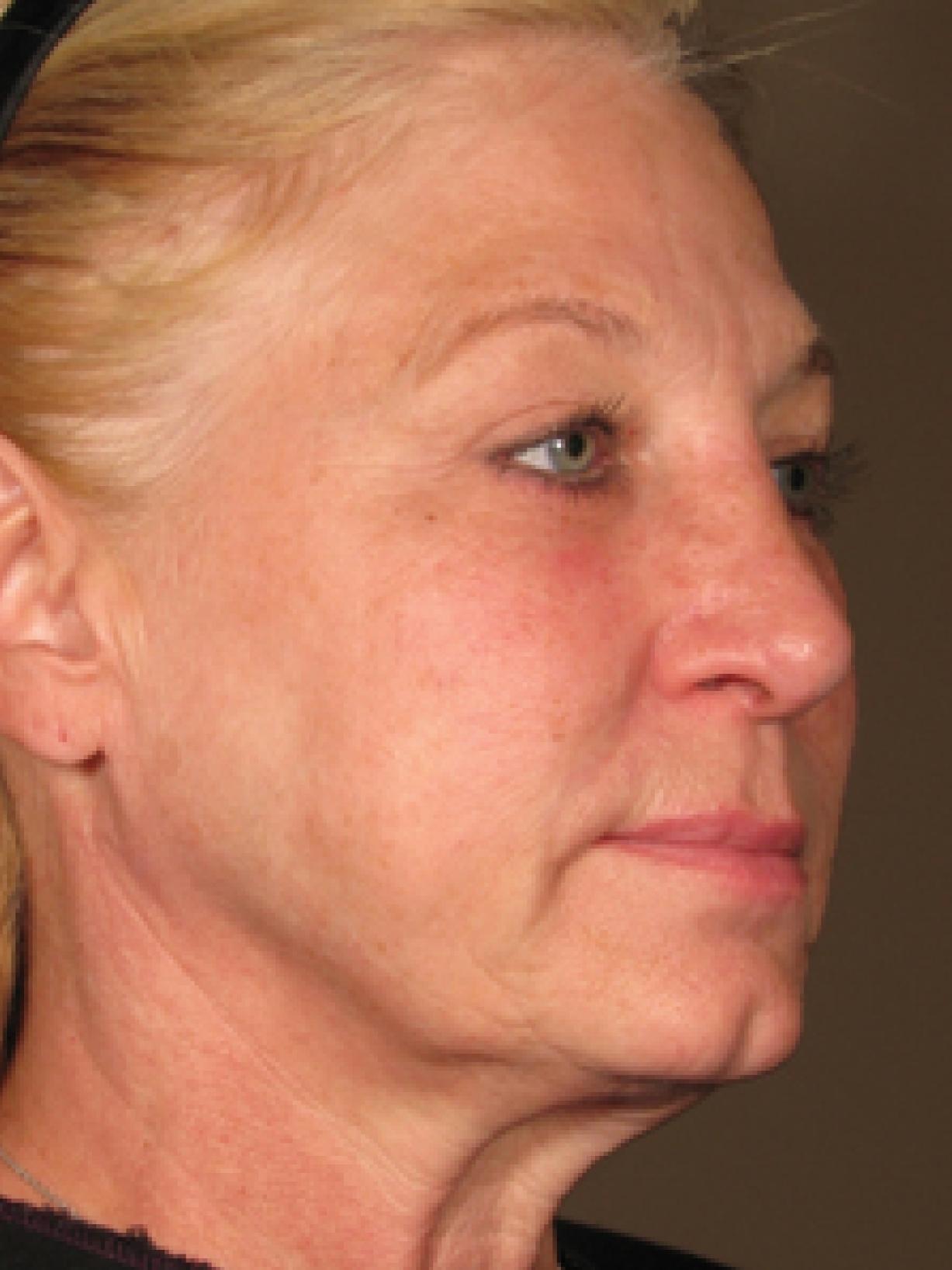 Ultherapy® - Face: Patient 4 - After  
