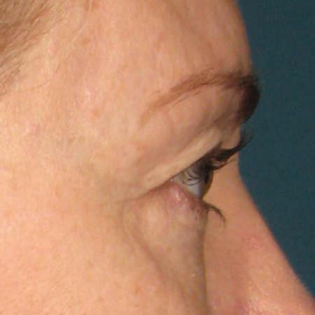 Ultherapy® - Brow: Patient 5 - Before 1