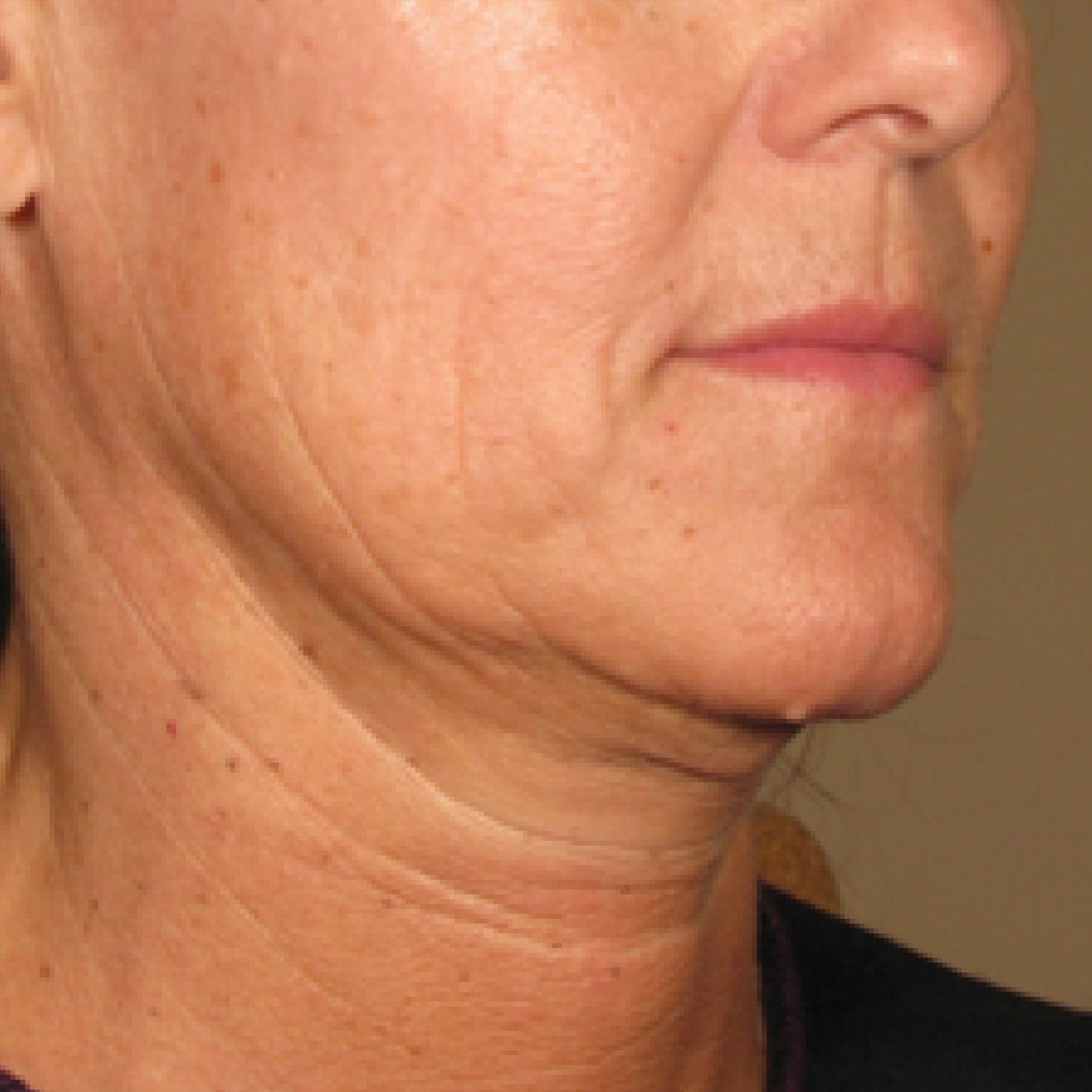 Ultherapy® - Chin: Patient 3 - Before 
